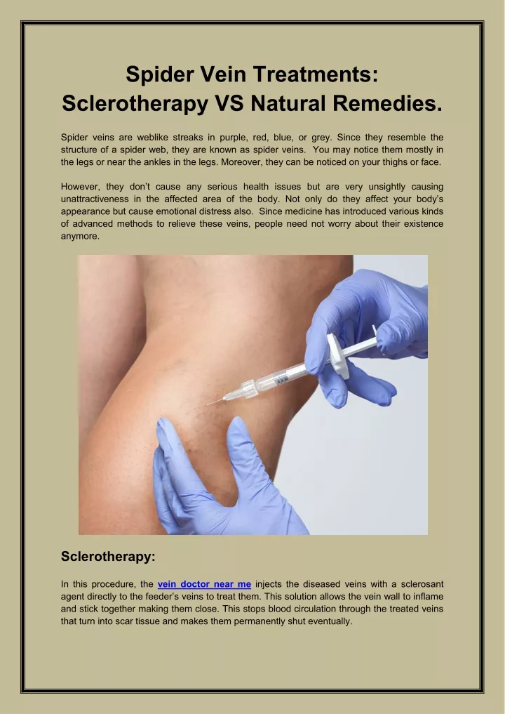 spider vein treatments sclerotherapy vs natural