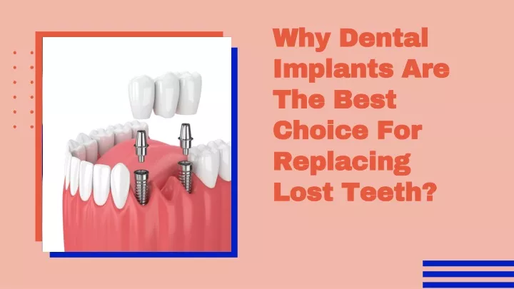 why dental implants are the best choice for replacing lost teeth