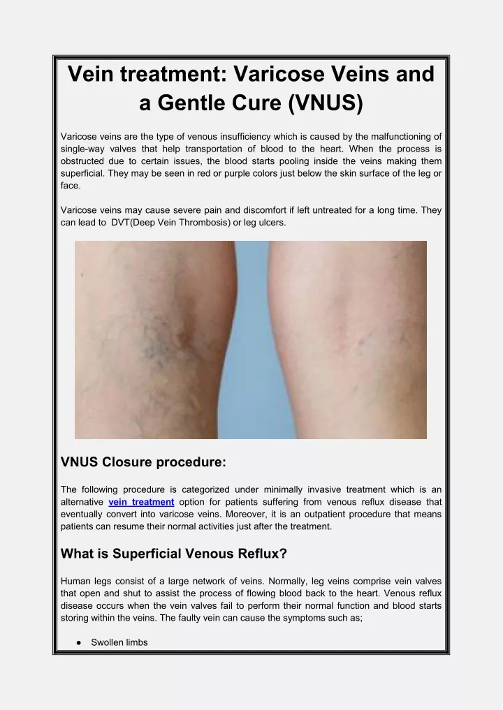 vein treatment varicose veins and a gentle cure