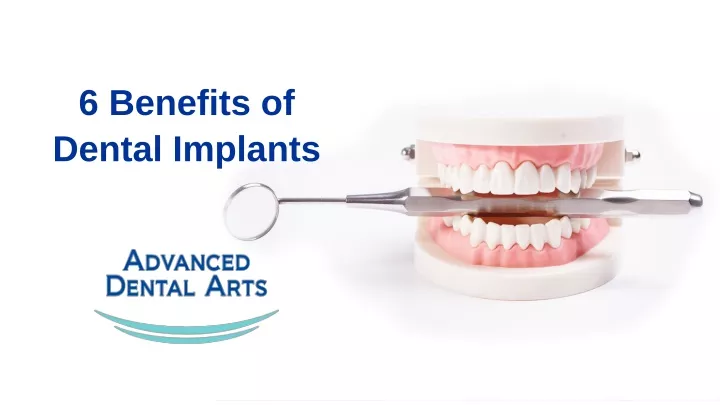 6 benefits of dental implants