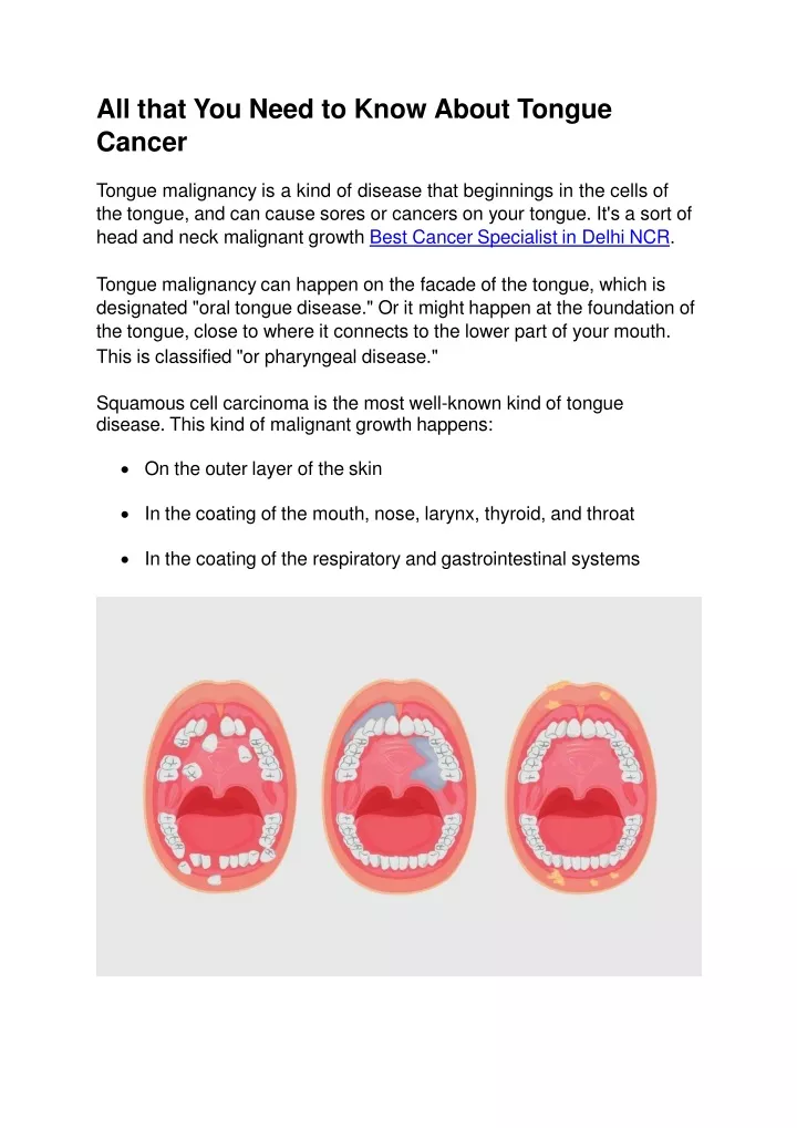 all that you need to know about tongue cancer