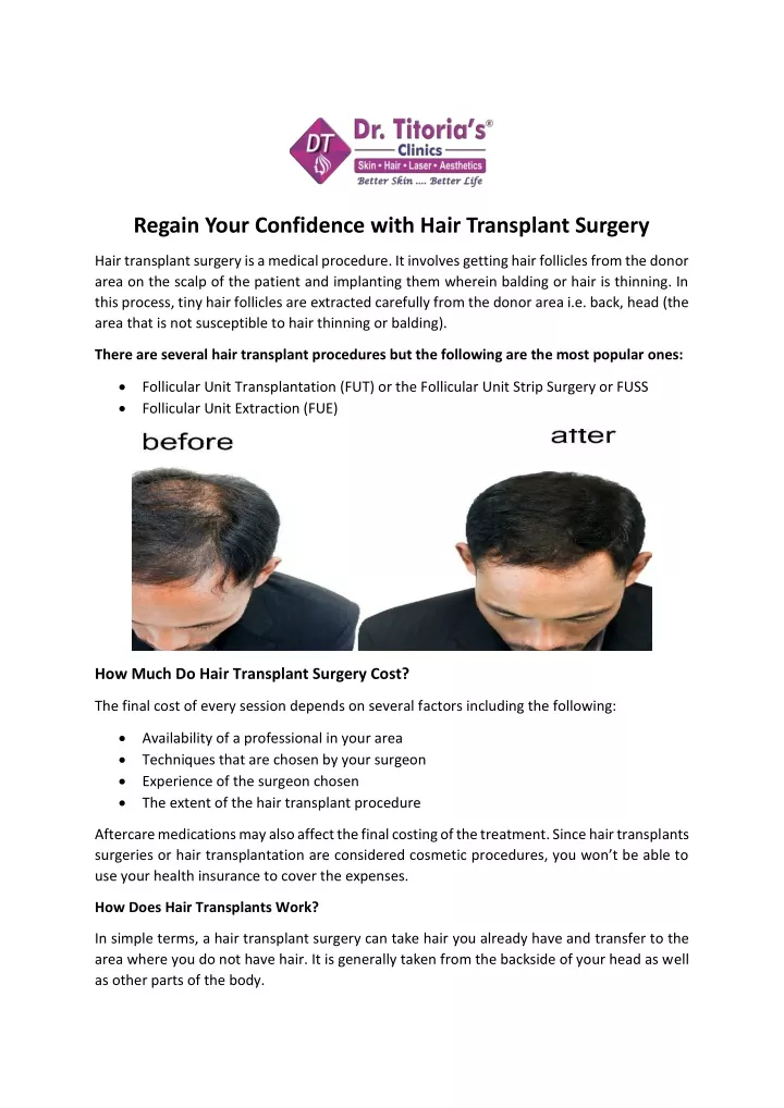 regain your confidence with hair transplant