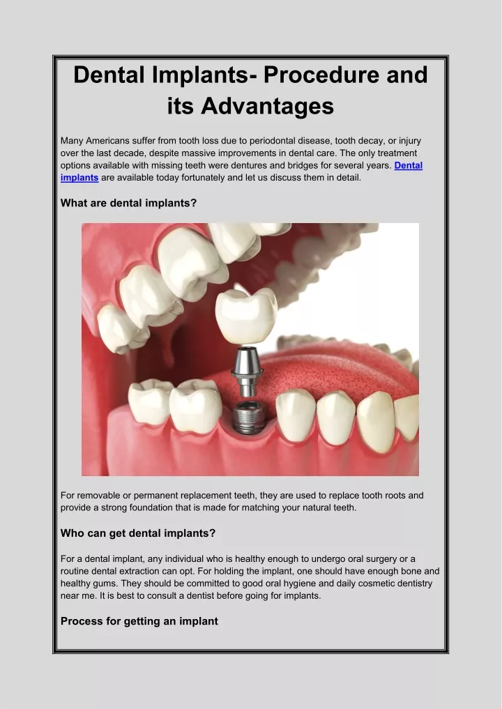 dental implants procedure and its advantages