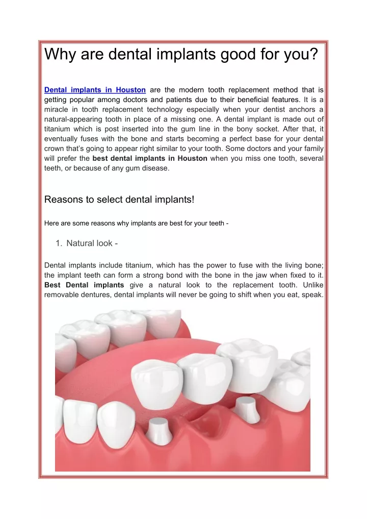 why are dental implants good for you