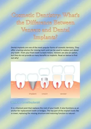 Cosmetic Dentistry: What's the Difference Between Veneers and Dental Implants?