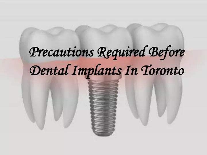 precautions required before dental implants in toronto