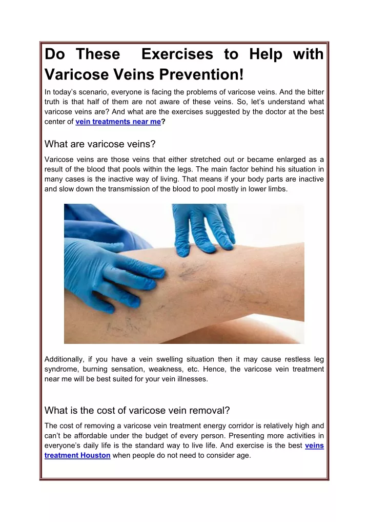 do these varicose veins prevention