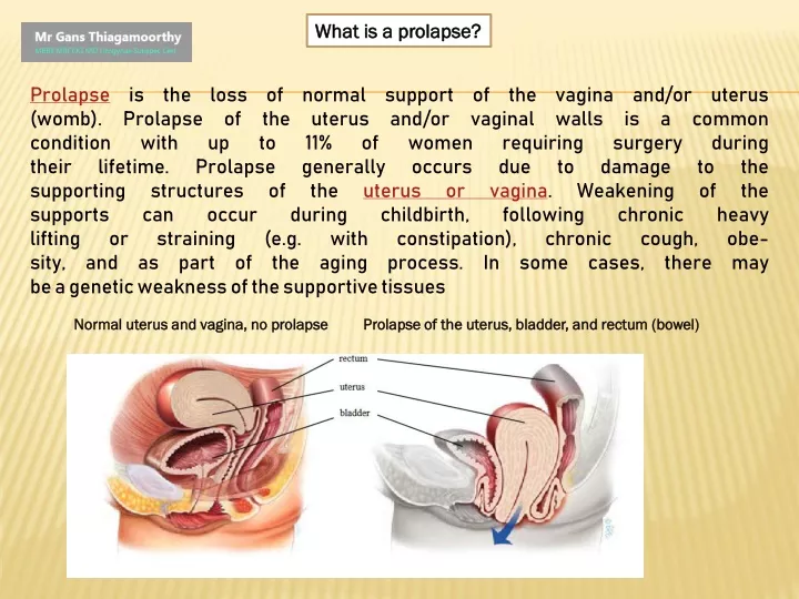 what is a prolapse