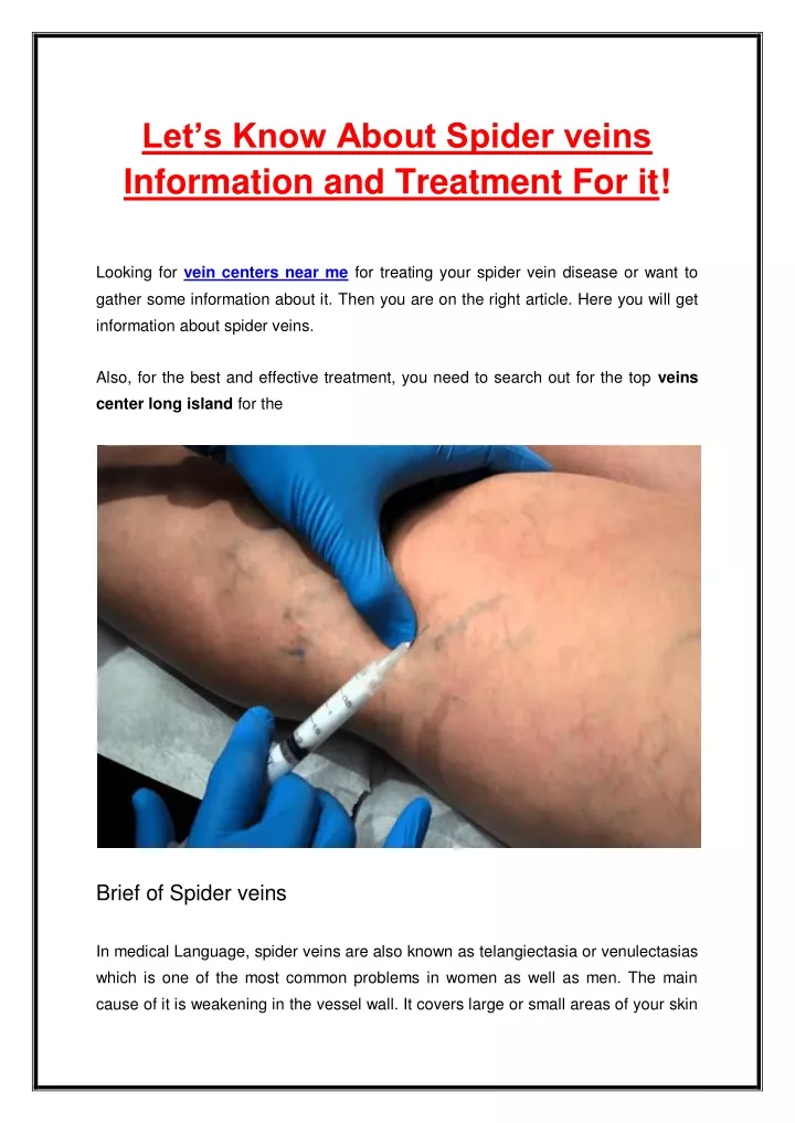 let s know about spider veins information
