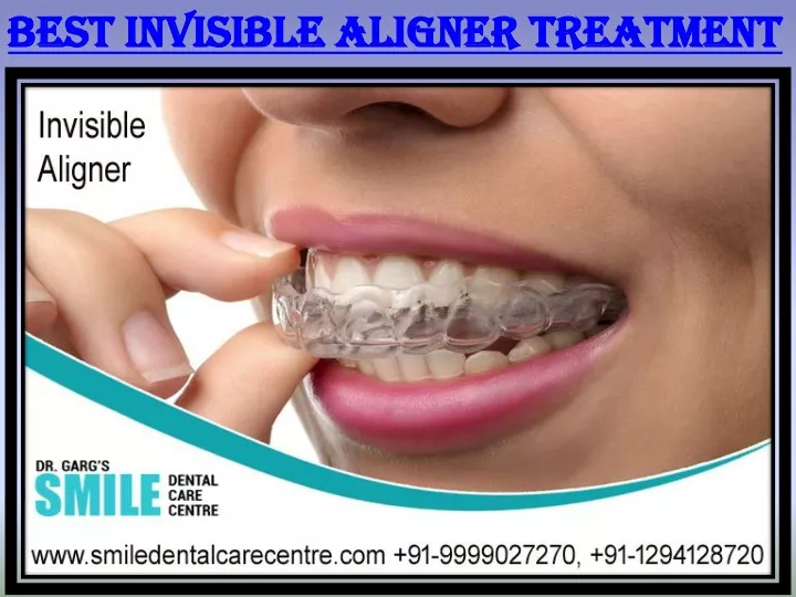 best invisible aligner treatment