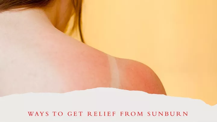 ways to get relief from sunburn