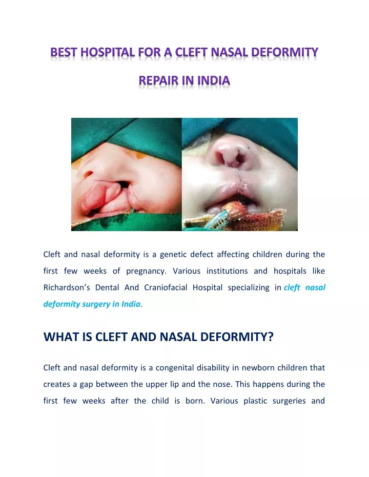 cleft and nasal deformity is a genetic defect