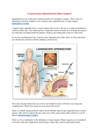 is laparoscopic appendectomy major surgery