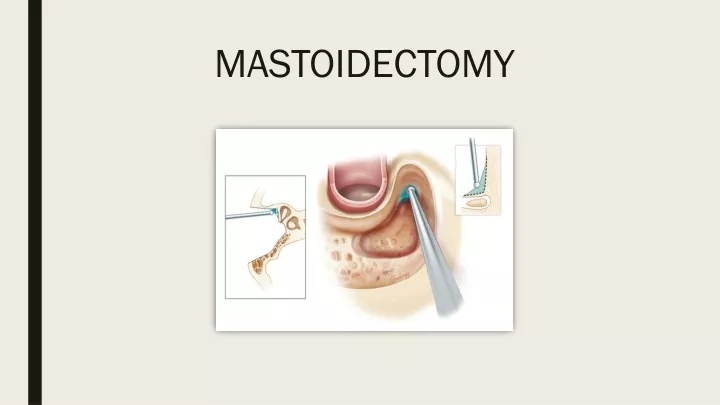 mastoidectomy