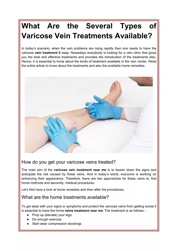 what varicose vein treatments available