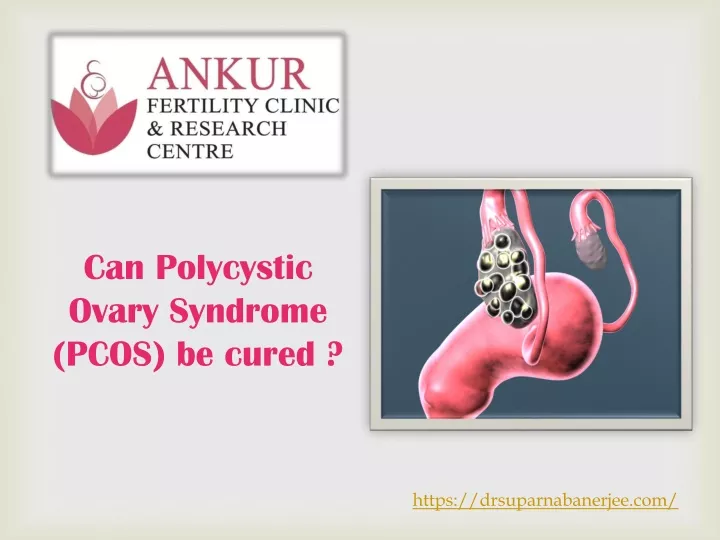 can polycystic ovary syndrome pcos be cured