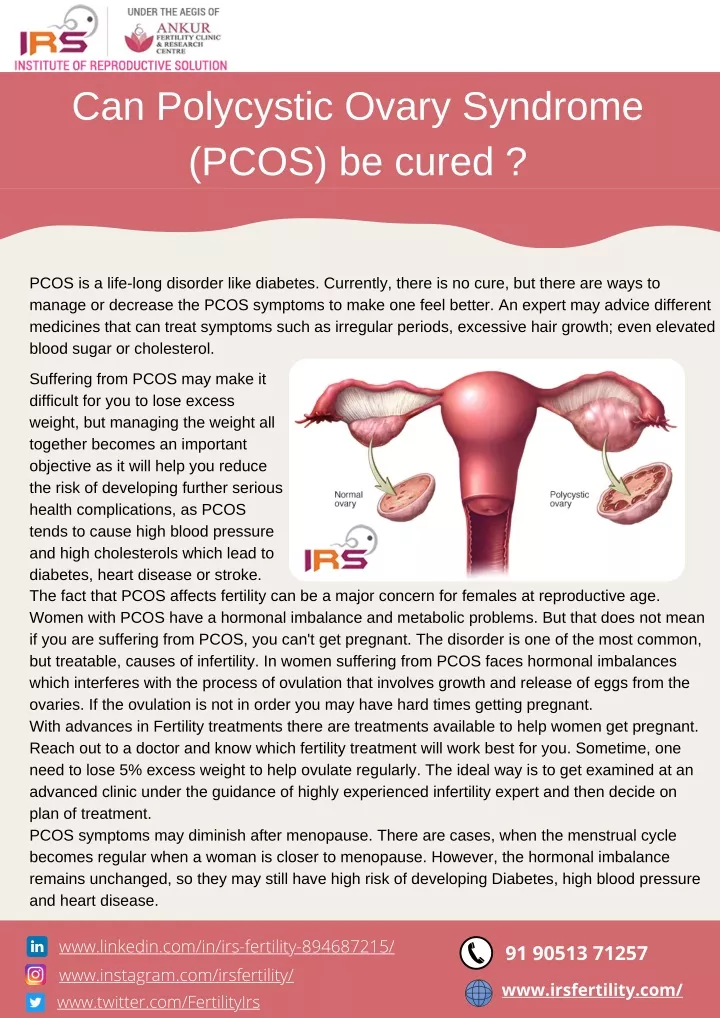 can polycystic ovary syndrome pcos be cured