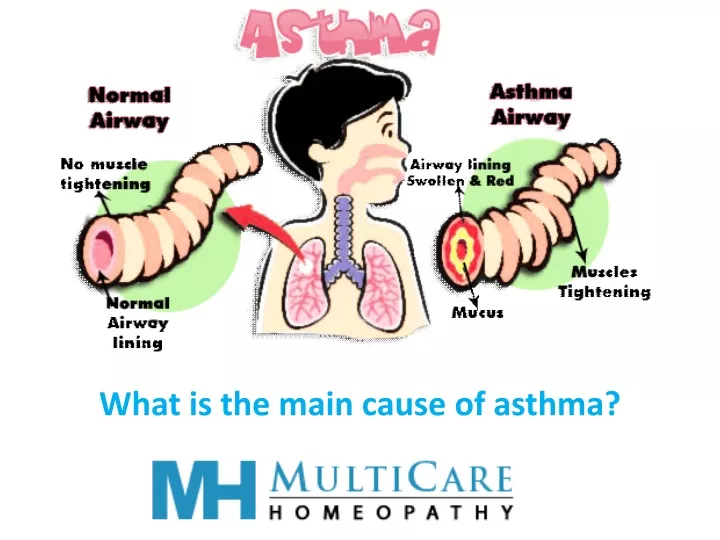 what is the main cause of asthma