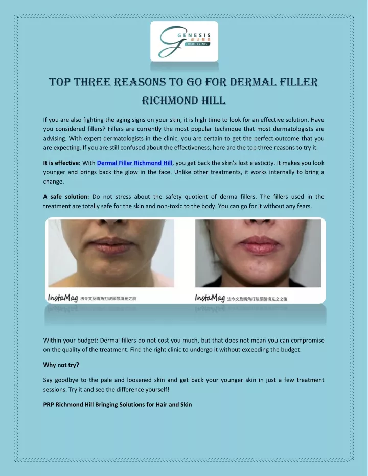 top three reasons to go for dermal filler