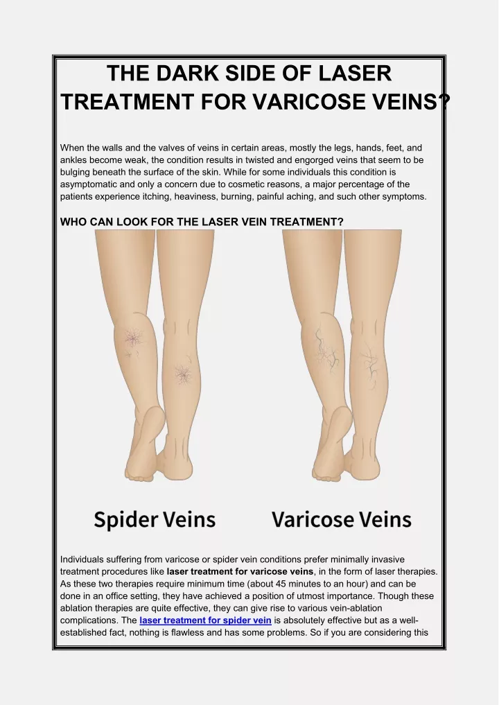 the dark side of laser treatment for varicose
