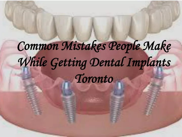 common mistakes people make while getting dental implants toronto