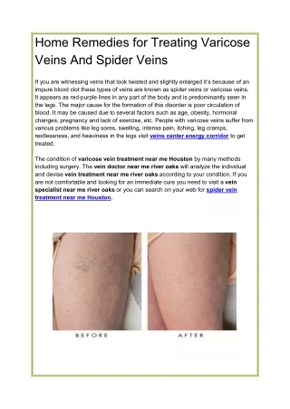 Home Remedies for Treating Varicose Veins And Spider Veins