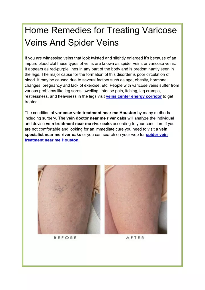 home remedies for treating varicose veins