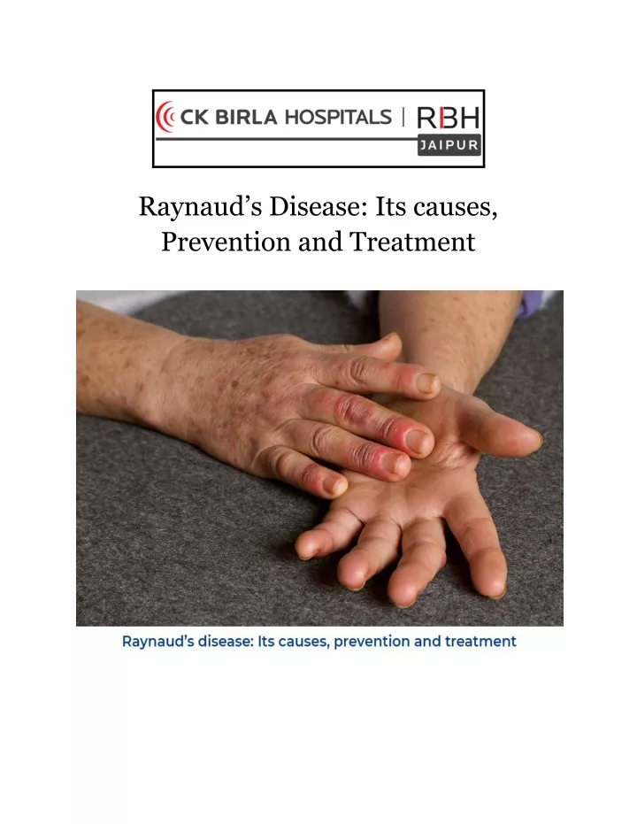raynaud s disease its causes prevention
