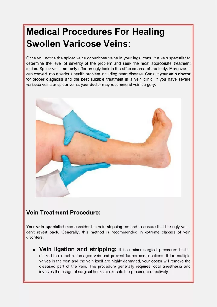 medical procedures for healing swollen varicose