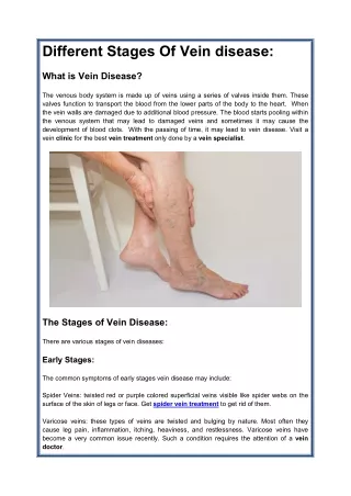 Different Stages Of Vein disease: