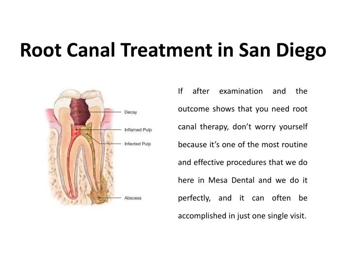 root canal treatment in san diego