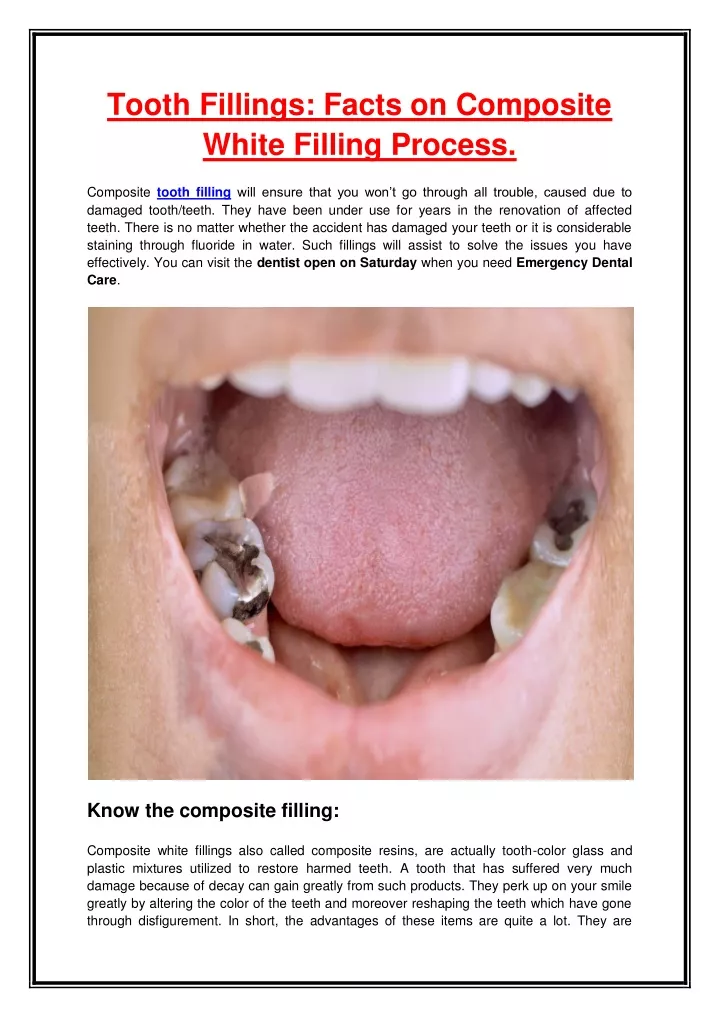 tooth fillings facts on composite white filling