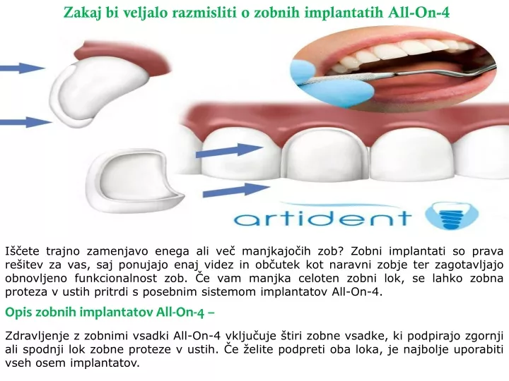 zakaj bi veljalo razmisliti o zobnih implantatih