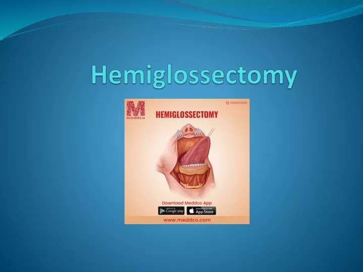 hemiglossectomy