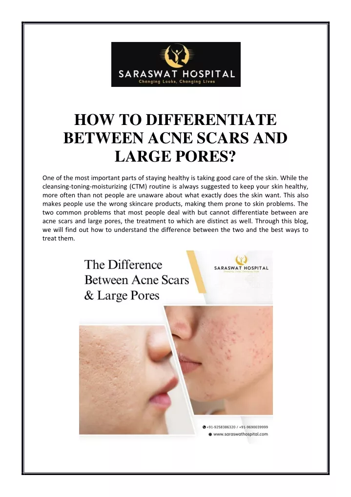 how to differentiate between acne scars and large