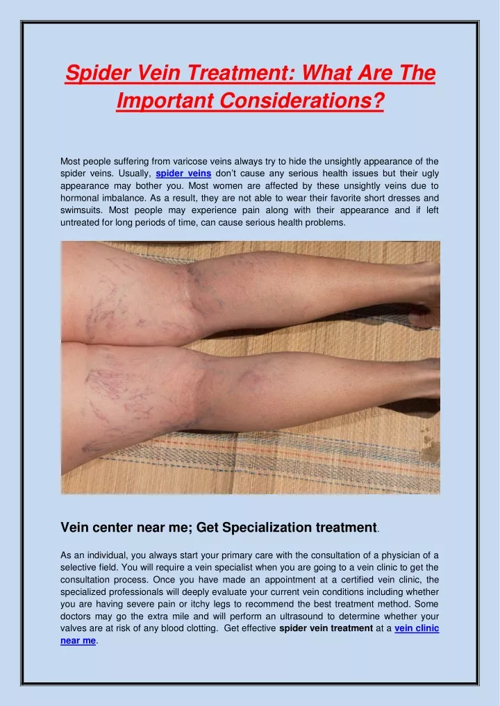 spider vein treatment what are the important