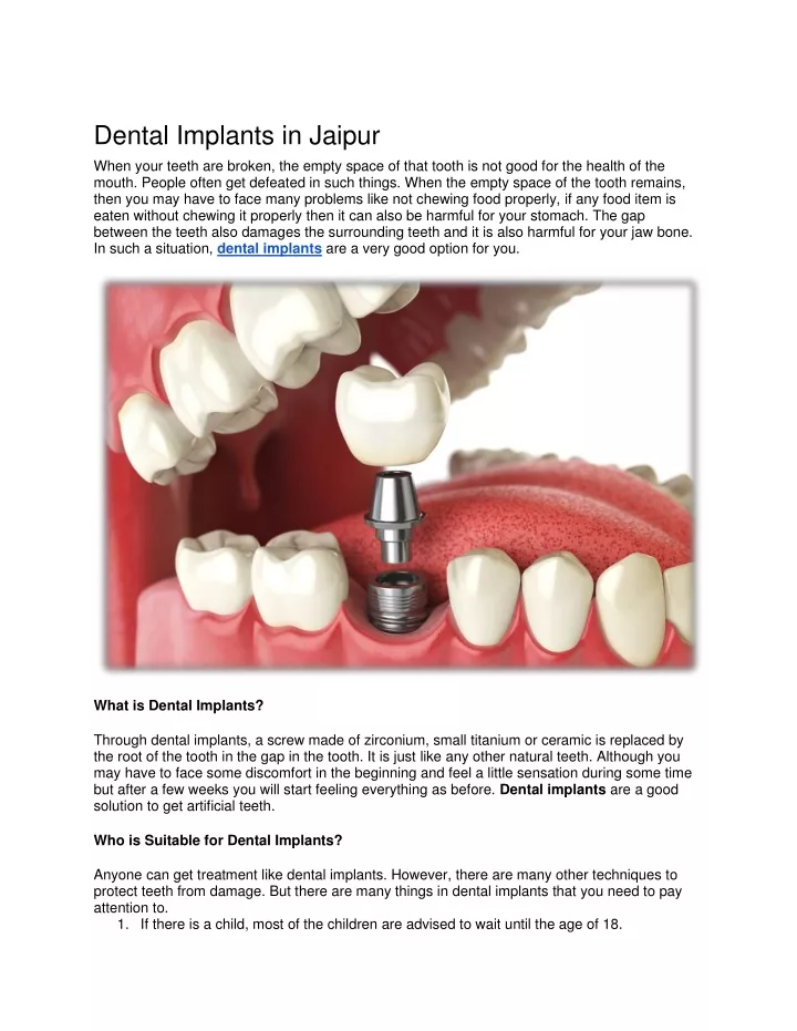 dental implants in jaipur when your teeth