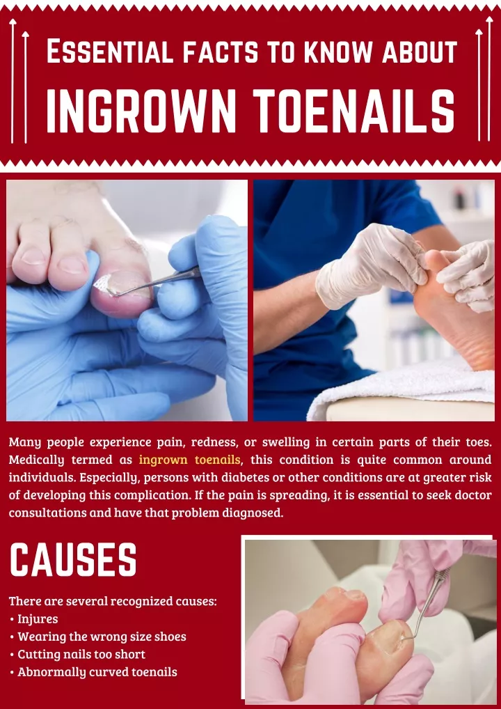 essential facts to know about ingrown toenails
