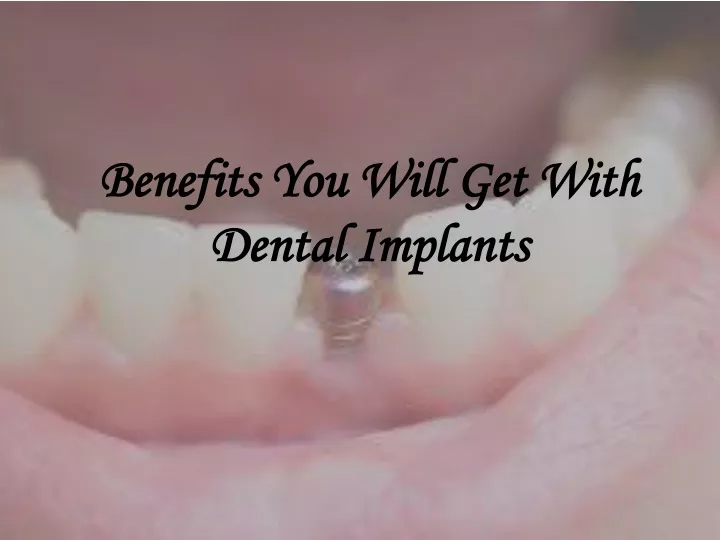 benefits you will get with dental implants
