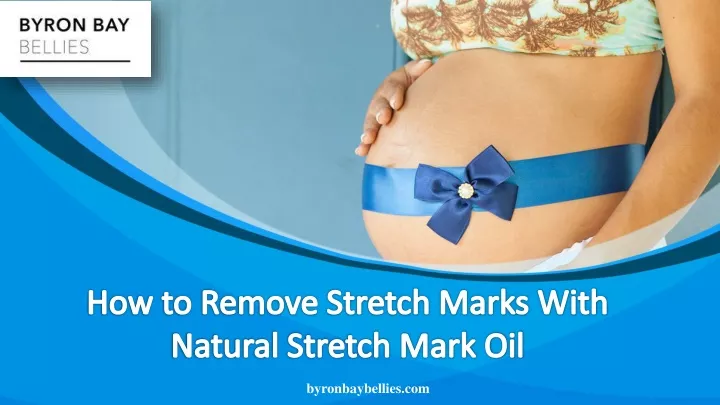 how to remove stretch marks with natural stretch
