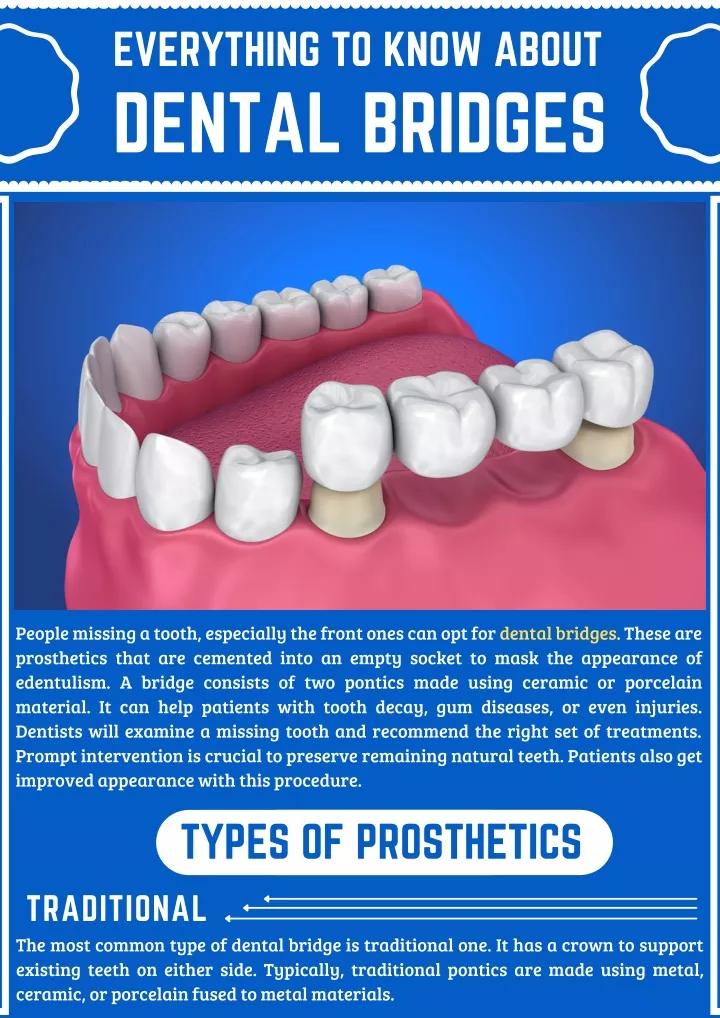 everything to know about dental bridges