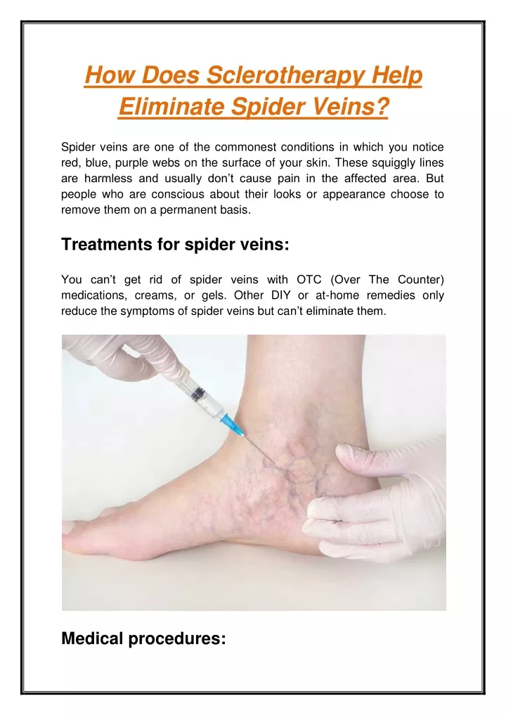 how does sclerotherapy help eliminate spider veins