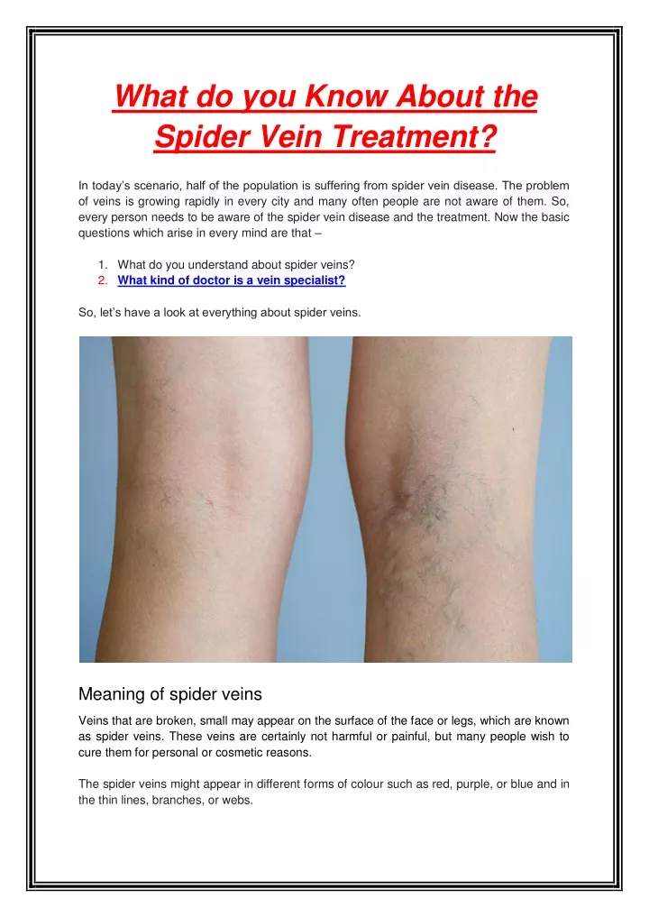 what do you know about the spider vein treatment