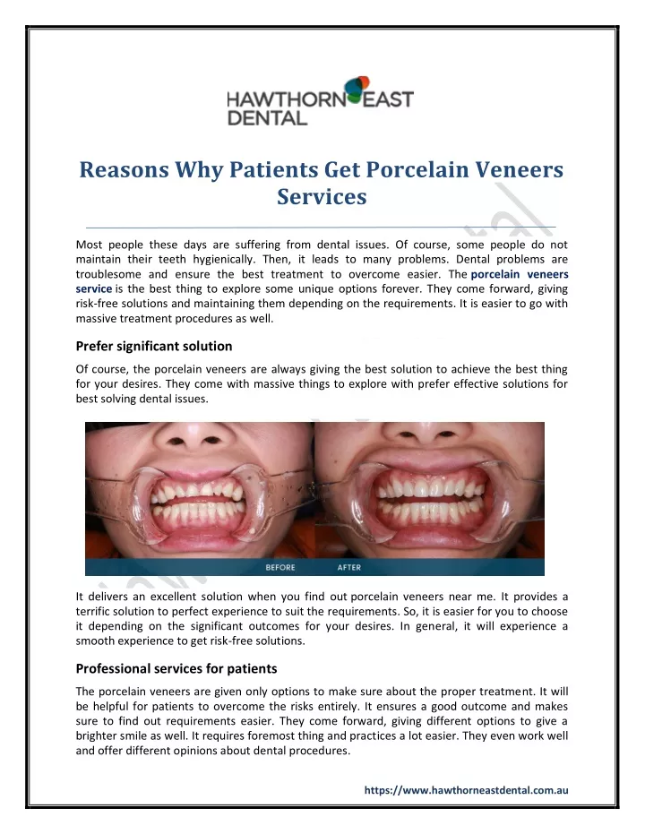reasons why patients get porcelain veneers