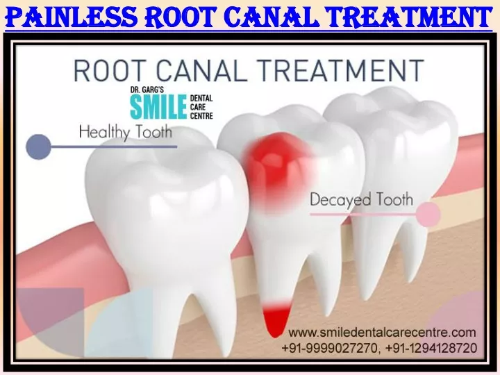 painless root canal treatment