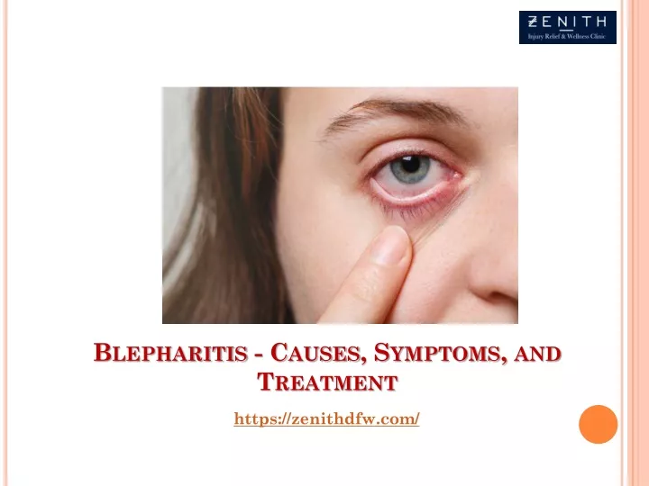 blepharitis causes symptoms and treatment