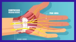 Carpal tunnel syndrome in symptoms