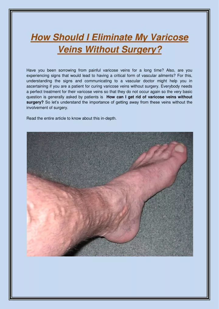 how should i eliminate my varicose veins without