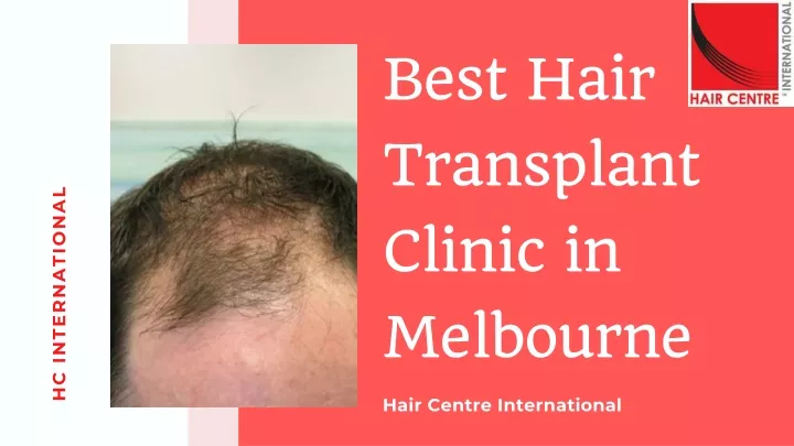 best hair transplant clinic in melbourne