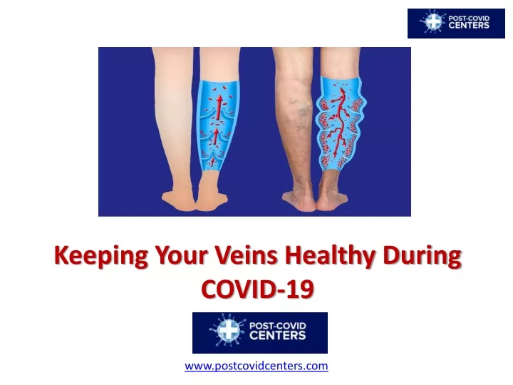 keeping your veins healthy during covid 19